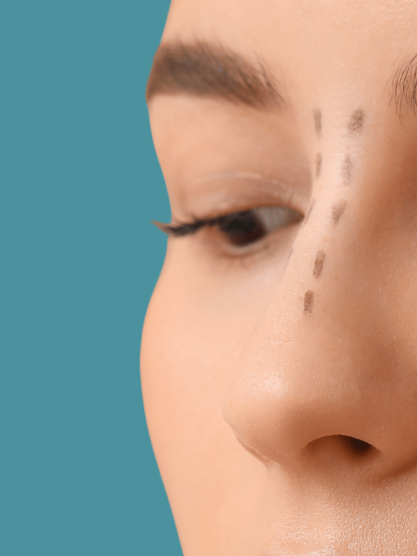 Rhinoplasty 600x800 Rhinoplasty 600x800
