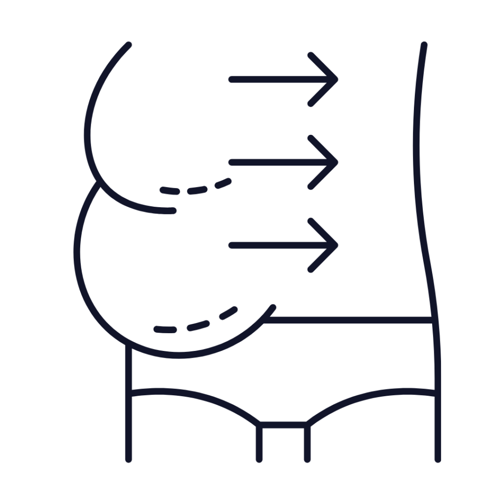Liposuction